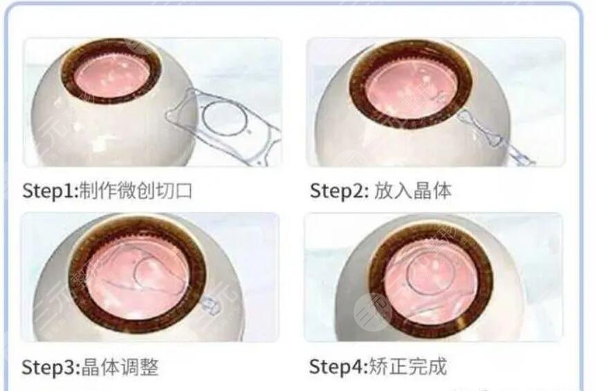 激光手术治近视眼会反弹吗?