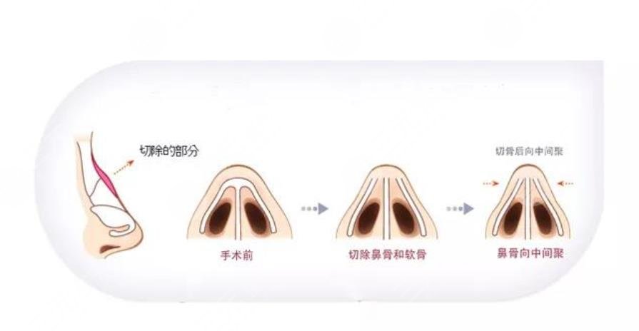 驼峰鼻手术一般多少钱?