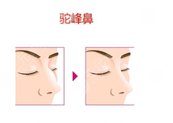 驼峰鼻手术一般多少钱?
