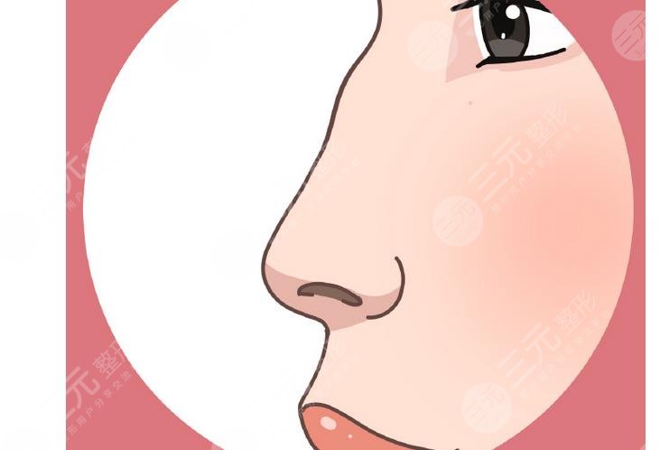 驼峰鼻矫正适合哪些人群?