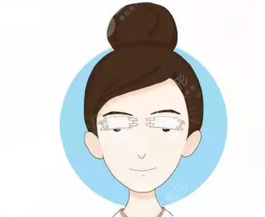 韩式双眼皮手术有哪些?