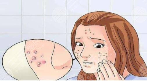 祛除痘印的方法有哪些？这4种方案值得你一试，很多人试过了都说不错~