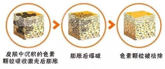 壹加壹整形美容医院激光脱腋毛好吗?