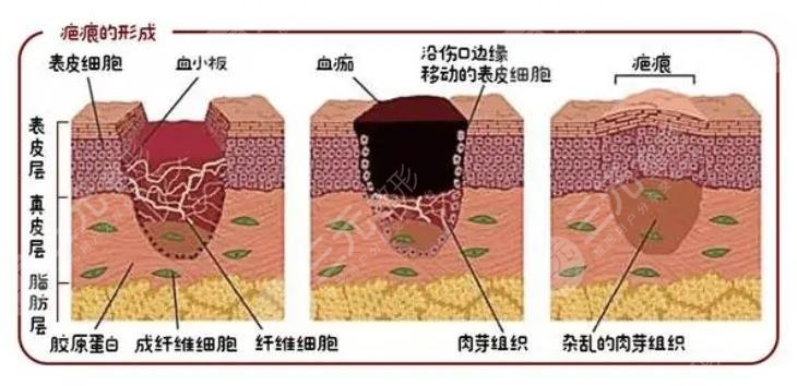 瘢痕和疤痕的区别,对比(第6页)_大山谷图库