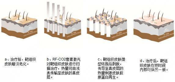 激光除皱手术怎么样?