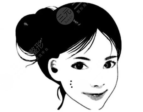 激光去痦子多少钱一次2023?