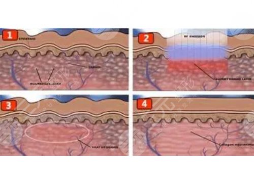深蓝射频多久做一次?