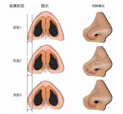 上海周俊杰隆鼻技术好不好?医生个人资料、做鼻子价格表、口碑荣誉一览~