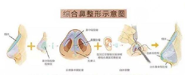 假体隆鼻效果如何?
