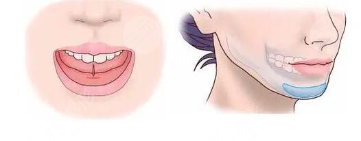 垫下巴多长时间恢复正常?