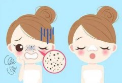 去黑头收缩毛孔医美用什么方法？3种项目可选，细滑美肌这样炼成！