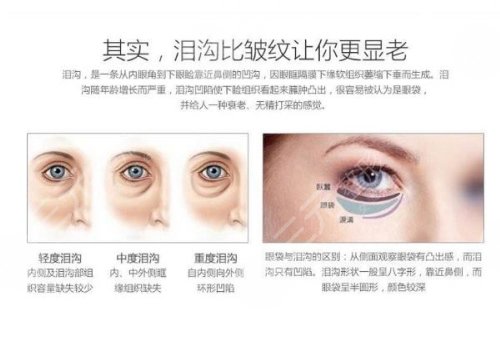 玻尿酸填充泪沟好不好?