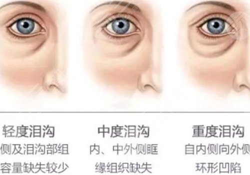 玻尿酸填充泪沟好不好?