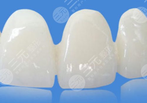 钴铬烤瓷牙和全瓷牙哪个好？