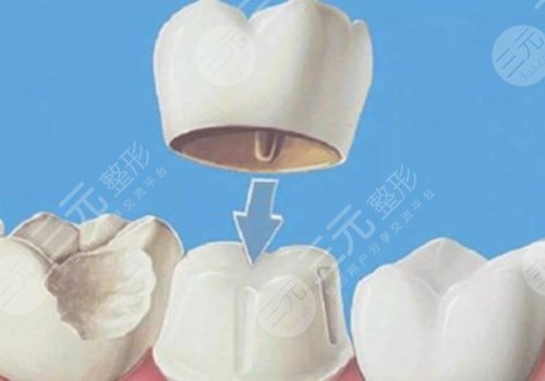 钴铬烤瓷牙和全瓷牙哪个好？