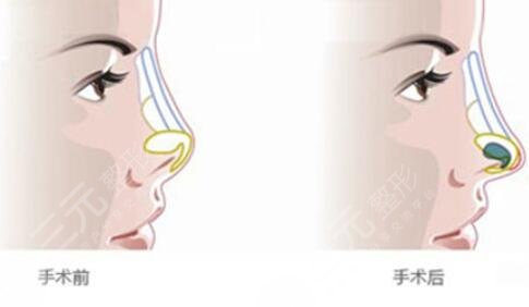 朱海杰和张策鼻基底哪个好？2位名医从技术、口碑、审美倾向综合打分~