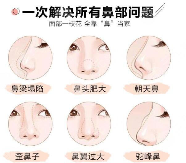 鼻基底整形手术