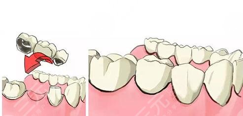 登腾种植牙的优点有哪些?