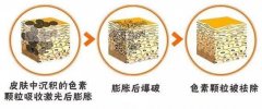 如何去除老年斑？3种方案分享，淡斑美肤不留龄感！