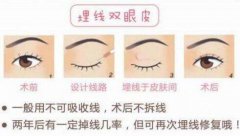 埋线双眼皮多久恢复正常？靓眼攻略细说术前术后的那些事！
