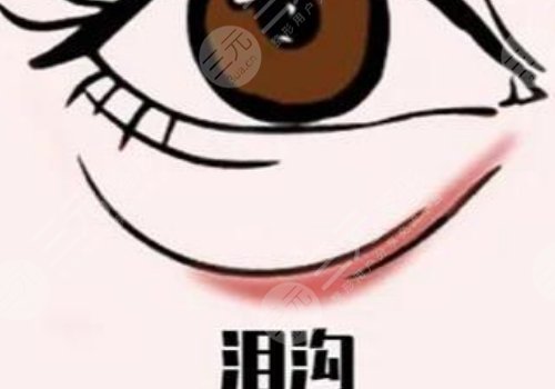 玻尿酸填充泪沟多久可以恢复自然？