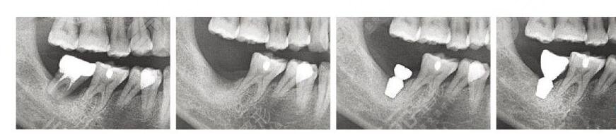 韩国登腾种植牙多少钱一颗2023?