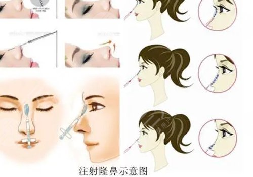 爱贝芙隆鼻会变宽吗?