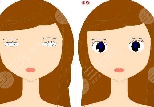 双眼皮全切恢复期要多久？