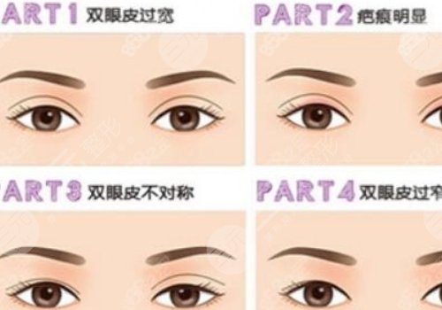 双眼皮修复大概多少钱呢?
