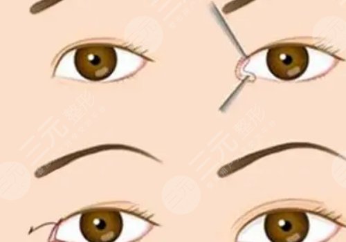 双眼皮修复大概多少钱呢?