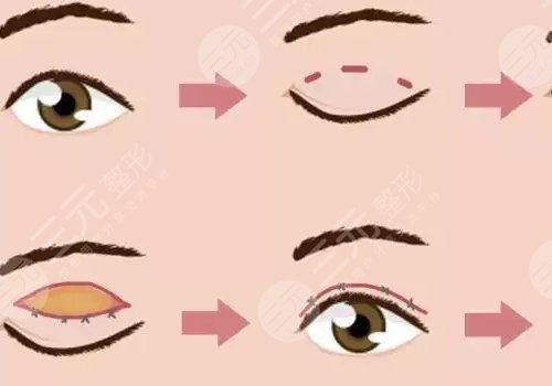 双眼皮修复大概多少钱呢?