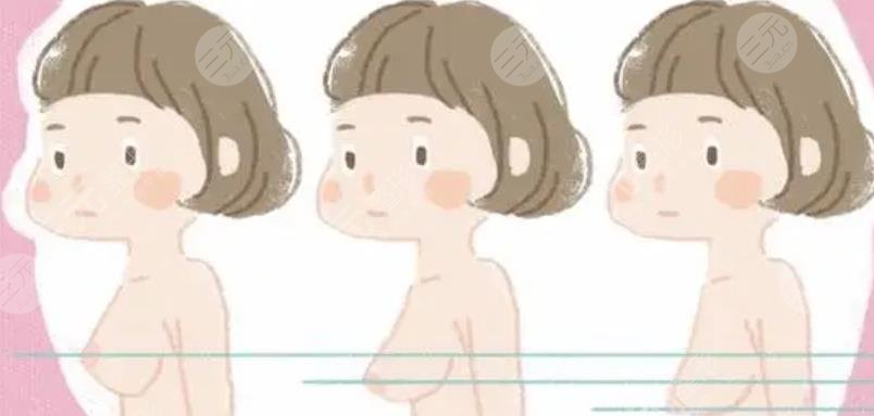 隆胸