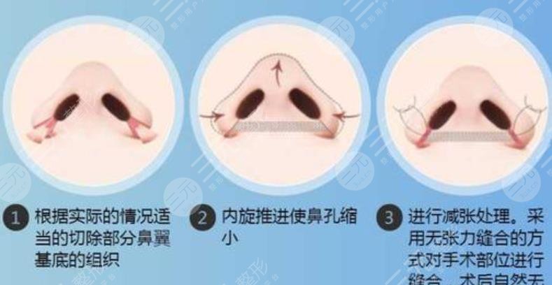 鼻翼