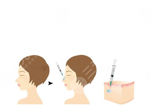 玻尿酸注射鼻头红肿和栓塞的区别是什么?