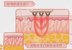 热玛吉的功效与功能有哪些？副作用、危害超全汇总！
