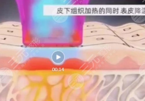 热玛吉的功效与功能有哪些？