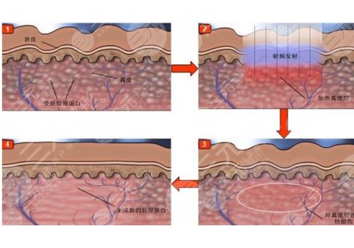 深蓝射频做一次有效果吗？