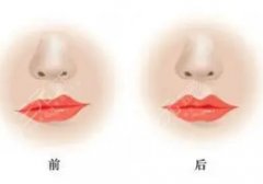 玻尿酸丰唇多久恢复自然？副作用、价格、注意事项汇总！