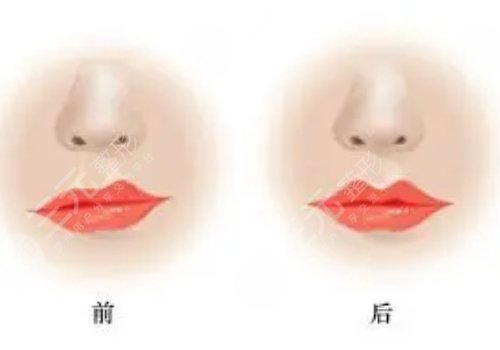 玻尿酸丰唇多久恢复自然？