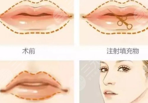 玻尿酸丰唇多久恢复自然？