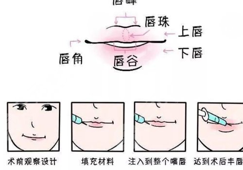玻尿酸丰唇多久恢复自然？