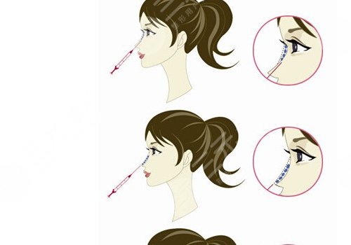 爱贝芙隆鼻会变宽吗