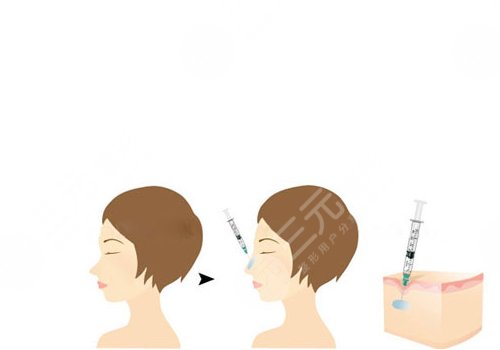 爱贝芙隆鼻会变宽吗