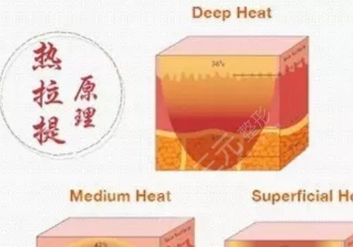 深蓝射频和热拉提哪个好？