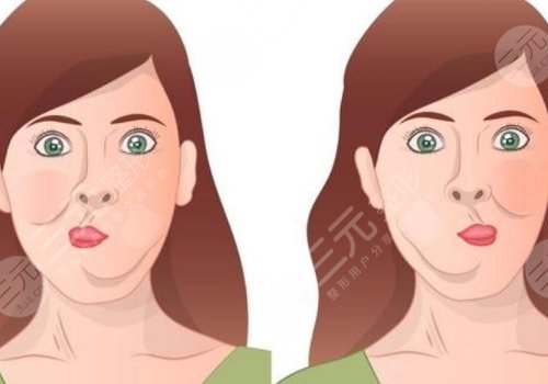 深蓝射频和热拉提哪个好？