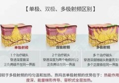 深蓝射频和热玛吉的区别有哪些？热门紧肤除皱项目测评！