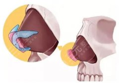 鼻小柱抬高是怎么做的？软骨移植法、鼻翼基底楔形切除法等介绍！