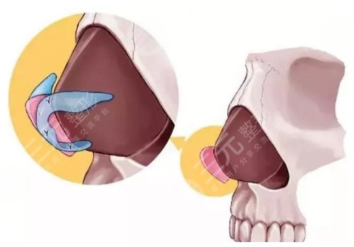 鼻小柱抬高是怎么做的?软骨移植法,鼻翼基底楔形切除法等介绍!