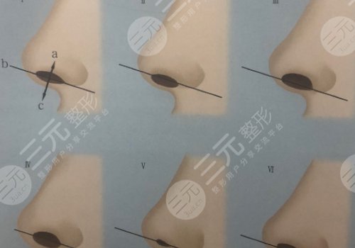 鼻小柱抬高是怎么做的？