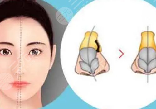 鼻小柱抬高是怎么做的？